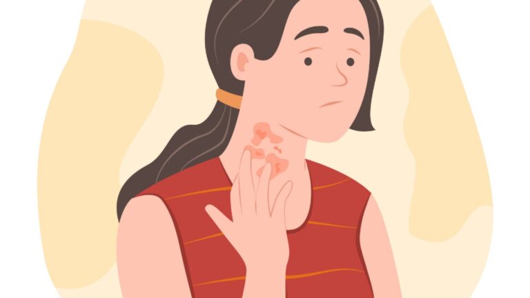 After Initial Denial, FDA Approves Sanofi/Regeneron’s Dupixent for Treating Chronic Hives