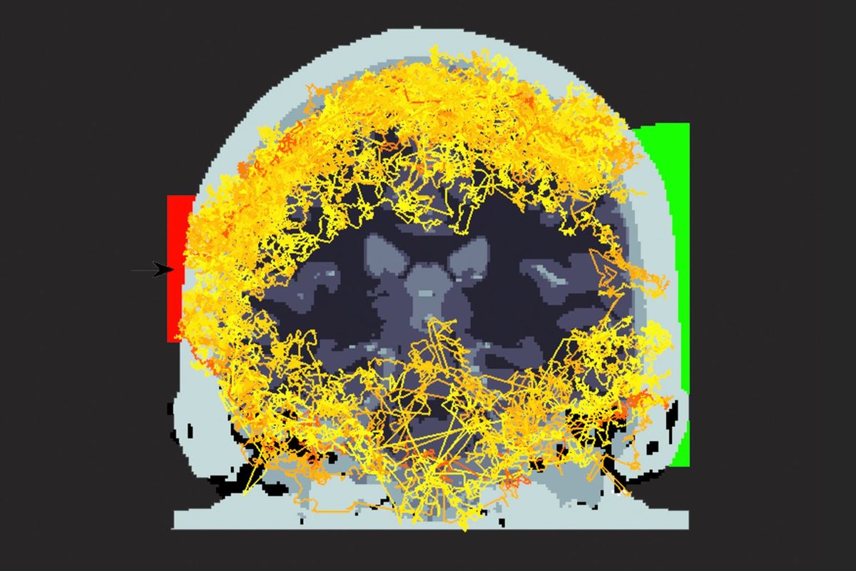 Researchers Direct a Laser Beam Through the Skull of a Human Subject