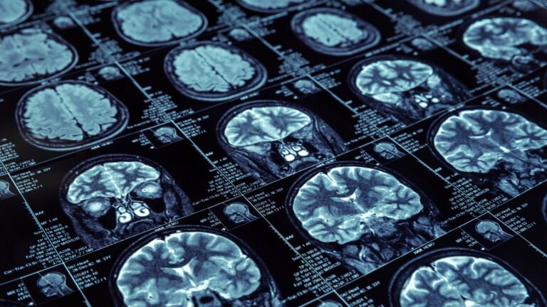 Eisai and Alzheon Explore Encouraging Outcomes in Alzheimer’s High-Risk Patient Group