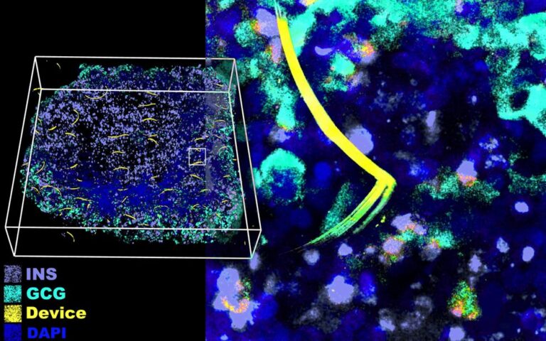 Innovative “Cyborg” Tissue May Accelerate Development of Treatments for Type 1 Diabetes