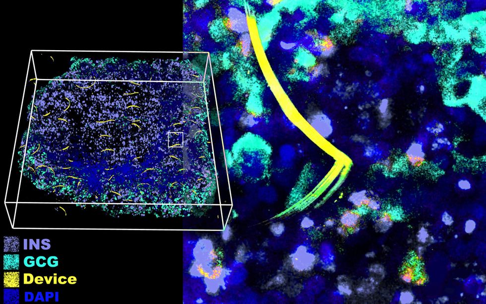 Innovative “Cyborg” Tissue May Accelerate Development of Treatments for Type 1 Diabetes