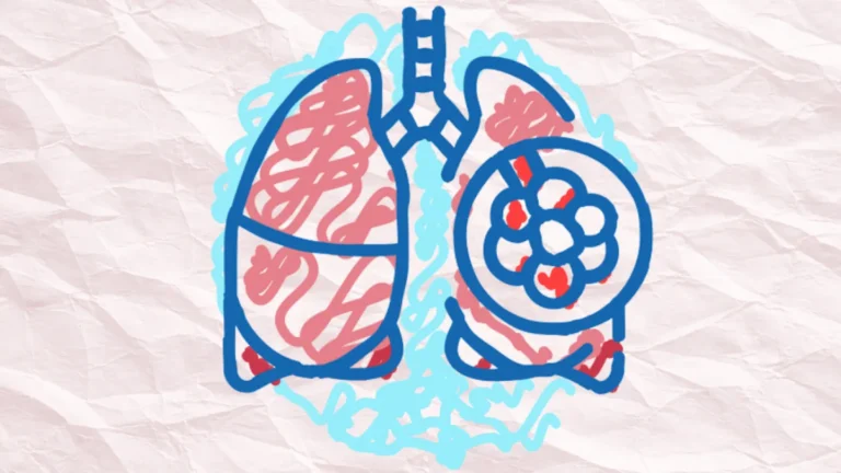 IPF Attracts Investor Interest as Biotech Companies Focus on Stopping Fibrosis and Enhancing Tolerability